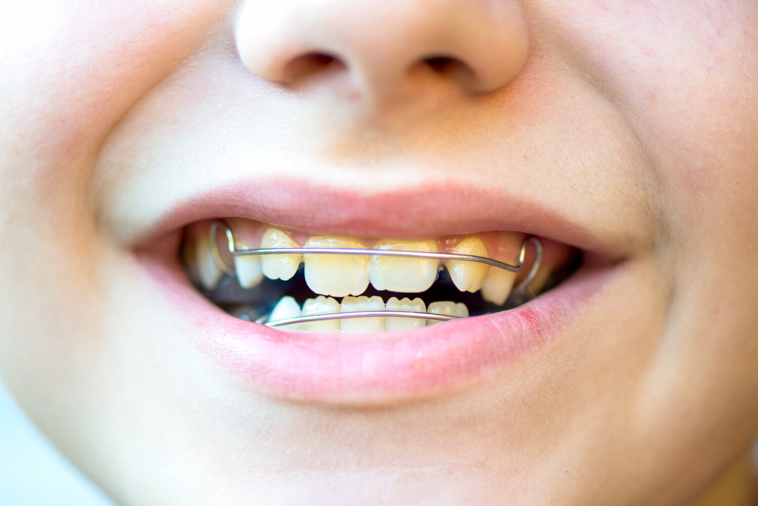 Boy with removable braces